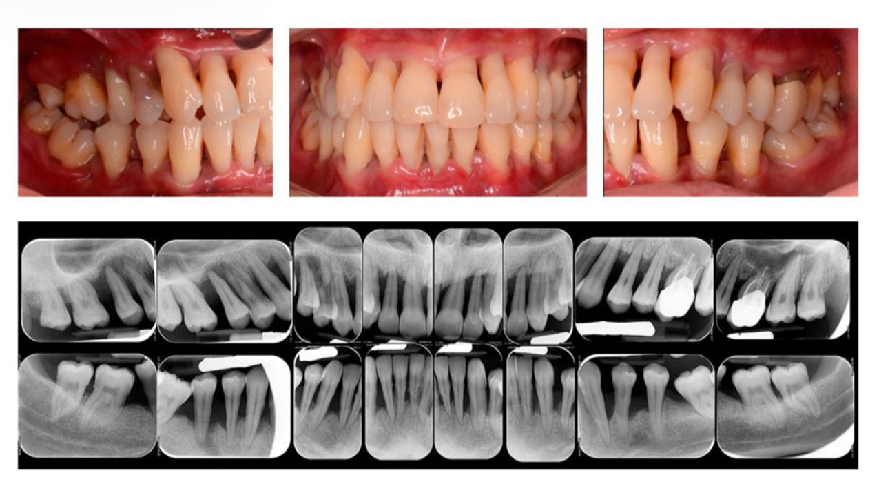 Waspada Penyakit Periodontal